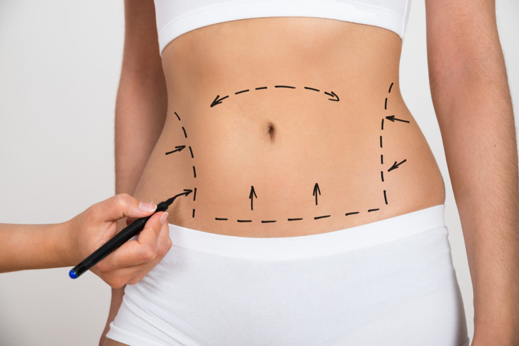 How soon can I Return To Work After Liposuction Surgery in Dubai